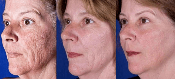 Result after laser facial skin resurfacing procedure