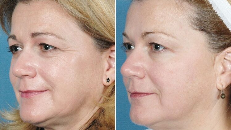 photos before and after skin rejuvenation with hardware
