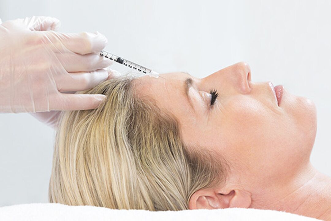 Plasmolifting is an injection method for facial skin rejuvenation. 